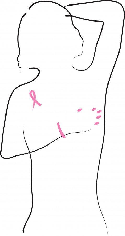 300 dpi Tom Borgman color illustration of woman doing self-exam, highlighted with pink fingernails and breast cancer awareness ribbon. St. Louis Post-Dispatch 2006 MCT Campus 